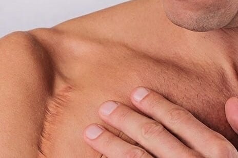 ENDERMOLOGIE - Endermothérapie